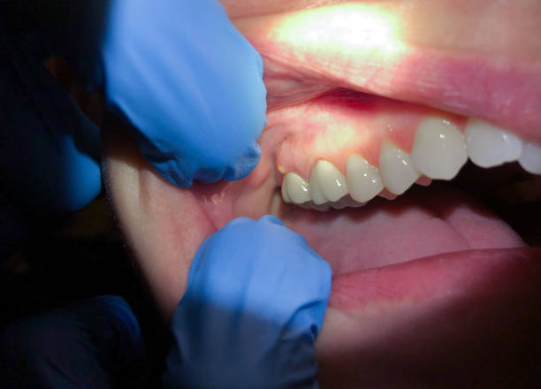 Best Emergency Root Canal Treatment in East Sonora, CA